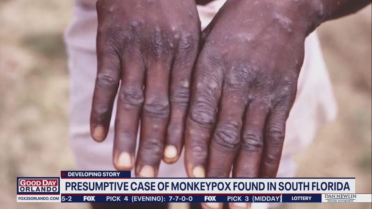 Monkeypox in Florida: These are the symptoms to watch for